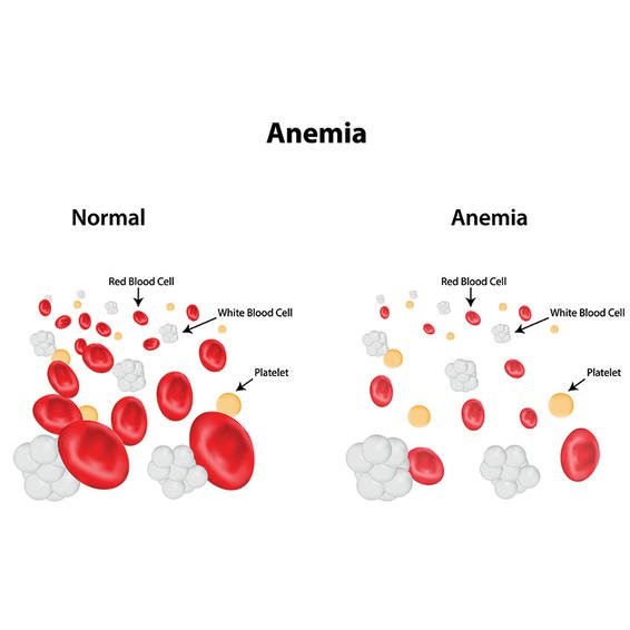 anemia